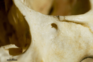 Maxillia bone and Infraorbital Foramen