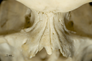 Nasal Bone