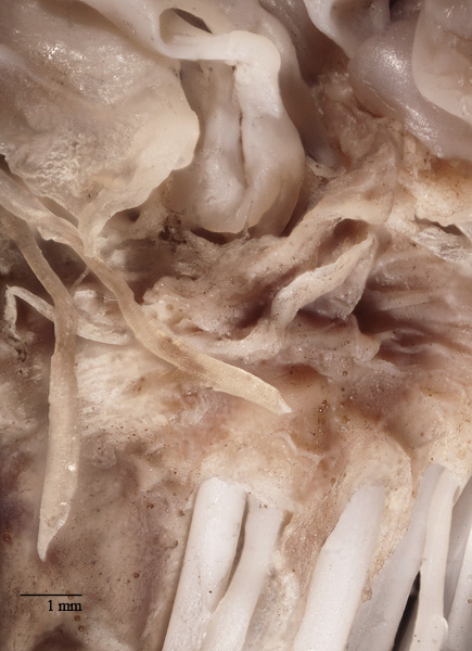 Mitral valve attachment to chordae tendineae