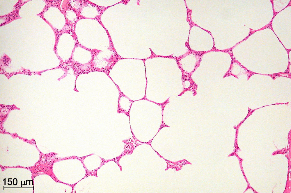 emphysema lung histology