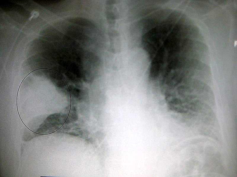 x-ray of lung with pneumonia