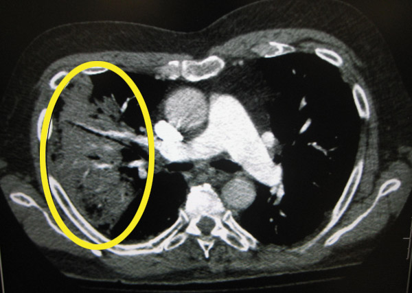 CT scan of Pneumonia in lung