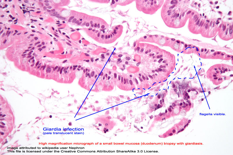 giardia infection